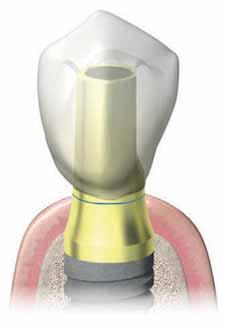 Questa assenza di spigoli vivi consentirà alle mucose di scorrere sul titanio senza trovare impedimenti e di raggiungere il profilo di adattamento stabilito dal protesista.