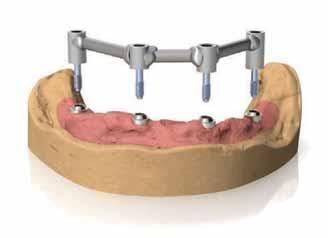 ANCORAGGIO CON ATTACHI SFERICI Fondere la barra o produrla tramite tecnologia CAD CAM. Provare la struttura prima su modello e poi in bocca al paziente per verificarne la completa passività.