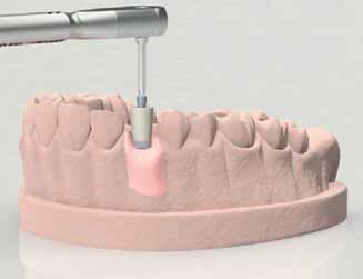 PROTOCOLLI DI UTILIZZO Riabilitazione provvisoria singola cementata su pilastro Simple in PEEK con base in titanio Avvitare un pilastro provvisorio Simple in PEEK