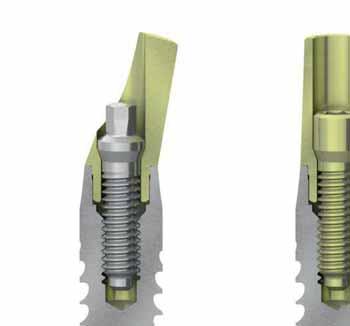 PROTOCOLLI DI UTILIZZO Riabilitazione definitiva con pilastri preformati I pilastri preformati dritti e angolati sono prodotti in titanio Gr.