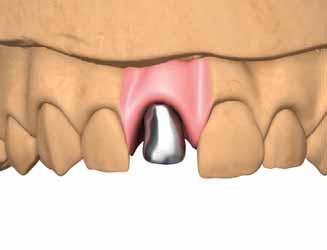 PROTOCOLLI DI UTILIZZO Provare la corona fusa su modello o in bocca al paziente per eventuali ritocchi.