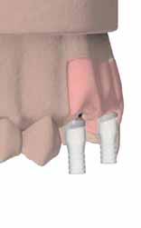 RIABILITAZIONE DEFINITIVA CON DYNAMIC ABUTMENT Riabilitazione definitiva multipla avvitata su Dynamic Abutment Sul modello di precisione fissare agli analoghi i Dynamic Abutment per mezzo dell