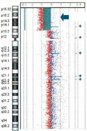 L esito di PrenatalSafe Karyo e dello studio del cariotipo mediante Array CGH concordano su una delezione di 34 Mb sul cromosoma 5 (Del5p15.32p13.2). ARRAY-CGH PRENATAL SAFE KARYO Chr. 5 Chr.