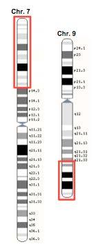 03 CASE REPORT DESCRIZIONE DEL CASO CLINICO Gestante di 32 anni portatrice consapevole di traslocazione reciproca si sottopone a PrenatalSafe Karyo alla 11 settimana con esito di traslocazione