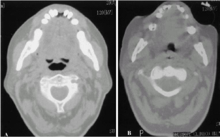 INEFFICACIA BULBAR MUSCLE FUNCTION IS INADEGUATE TO PERMIT FULL VOCAL CORD OPENING