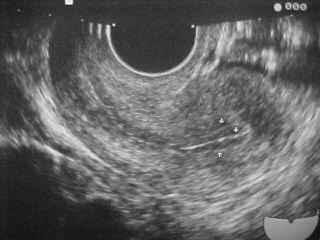 Pag. 5 di 13 L endometrio della ricevente deve essere stimolato per raggiungere uno spessore adeguato a garantire la maggior probabilità di impianto degli embrioni.