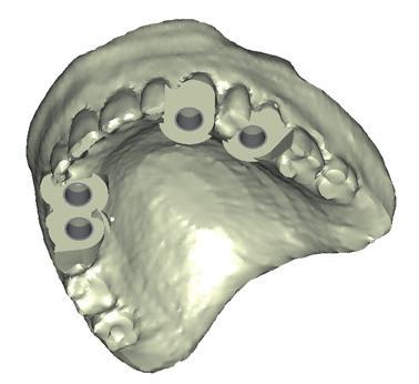 3. GUIDA CHIRURGICA Dopo la pianificazione dell intervento, gli elementi vengono inviati a Materialise Dental che realizza la guida