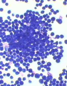 LINFOMI: QUADRO CITOLOGICO Strisci sempre molto cellulati.