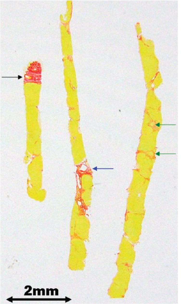 COLLAGEN PROPORTIONATE AREA Tsochatzis et al.