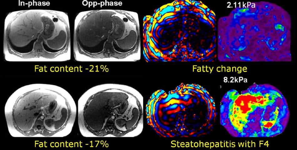 ELASTO RMN biopsia: steatosi steatosi semplice biopsia: