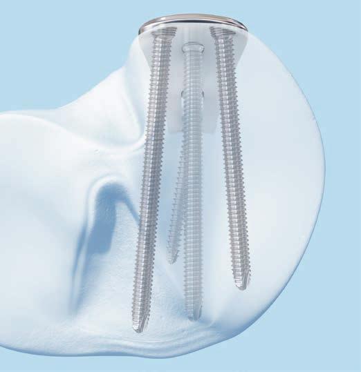 placche. La placca LCP 3.5 per tibia prossimale posteriore mediale è disponibile in acciaio o in titanio ed ha un profilo del corpo a contatto limitato.