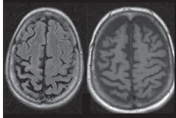 Degenerazione Corticobasale Imaging RM Atrofia fronto-parietale asimmetrica, iperintensità in T2 della corteccia
