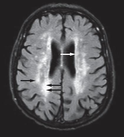 Parkinsonismo vascolare Imaging RM Anomalie della SB sottocorticale Lacune nei gangli della base Dilatazione