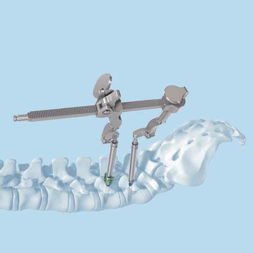 Tecnica facoltativa Distrazione per fusione intersomatica posteriore Inserire entrambi i pilastri del distrattore negli attacchi del distrattore.
