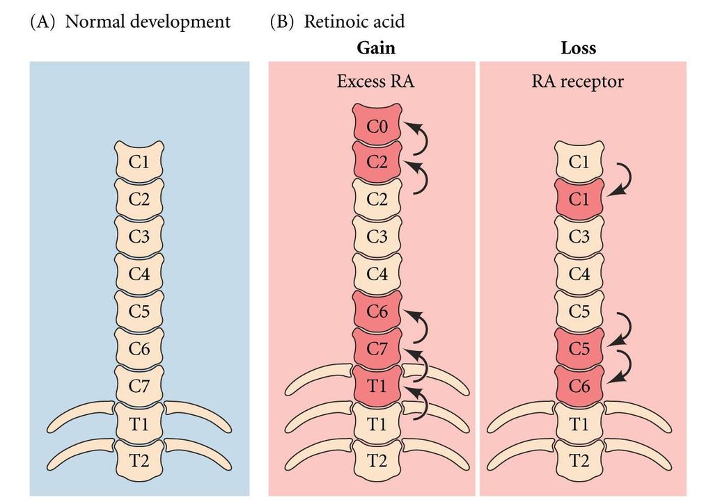 Retinoic acid teratogenesis The