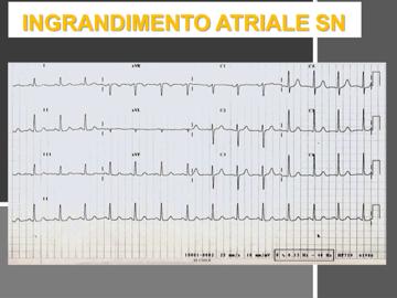 Gli atri difficilmente si ipertrofizzano, solo nelle patologie congenite, nell adulto tendono più a dilatarsi, ma se aumenta la durata quale sarà l atrio responsabile dell aumento della massa?