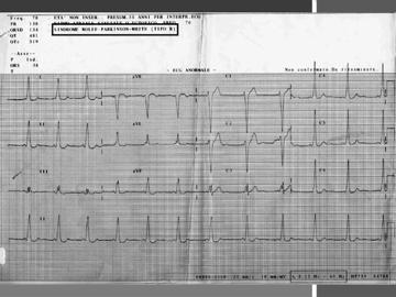 E questo il tipico esempio di PR corto, che porta alla sindrome di Wolf Parkinson White che può portare ad aritmie potenzialmente letali sopraventricolari.