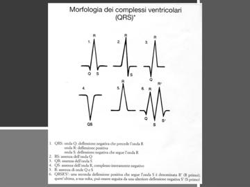 (Guardiamo il primo QRS, non si trova quasi mai così; guardiamo RS, si trova in prima seconda terza derivazione periferica; la Q generalmente va escluso che non rappresenti un indice di pregressa