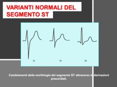 Il prof riporta un esempio di tracciato in cui l ST stacca non sull isoelettrica ma appare 2 mm sopra l isoelettrica in V2 e V3.