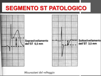 sopraslivellato) ma la R non scende proprio all isoelettrica ma passa direttamente all onda T che appare molto anticipata.