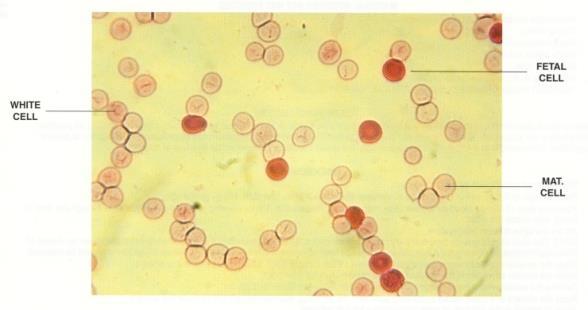 The Kleihauer-Betke (KB) Test Acid elution of Hb A (citric or hydrochloric/fecl acid buffers) Staining with erythrosin