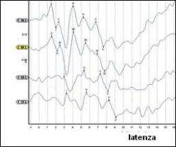 Diplopia (visione sdoppiata) e cefalea con nausea e vomito, con papilla da stasi e incontinenza urinaria sono i sintomi da ipertensione endocranica legata a neurinomi di grandi dimensioni con