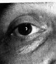 Valutazione dell allineamento degli occhi L allineamento è facilmente valutabile osservando la localizzazione della luce riflessa sulla cornea Se la luce è al centro della cornea in un occhio ma non