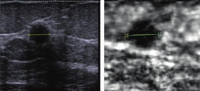 L uso di una funzione copia o ombra consente di duplicare la misurazione effettuata sull immagine B-mode nella stessa posizione sull elastogramma (linee gialle).