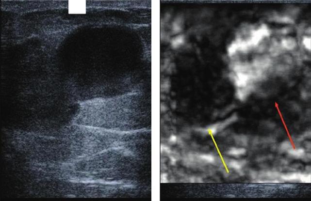 Figura 3.16 Caso riguardante una donna di 75 anni con sintomi di emorragia e risultati anomali all esame di mammografia diagnostica.