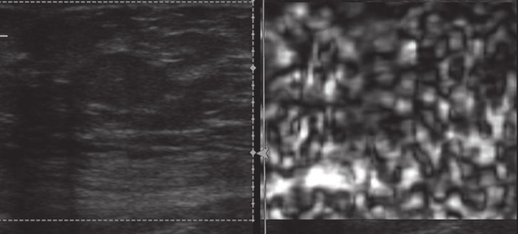 Questo esempio di artefatto da slittamento riguarda un lipoma.