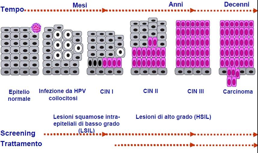 Storia naturale del carcinoma della cervice uterina SItI