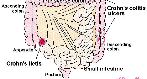 Morbo di Crohn (NOD2) una patologia multifattoriale grave a carico dell intestino infiammazione transmurale a chiazze lungo tutto il tratto gastrointestinale sintomi extra-intestinali a carico di