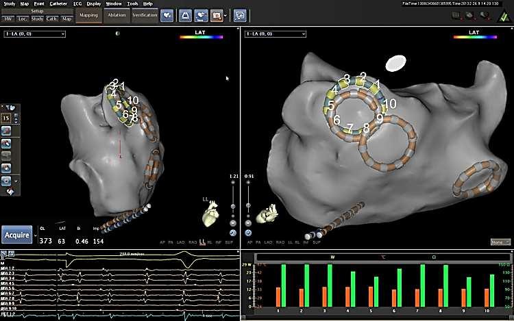 41 Tecnologia ACL (Advanced Catheter Location) Per poter impiegare tale tecnologia, vengono applicati sul paziente dei patch (3 patch anteriori); ogni patch è dotato di un sensore elettrico (Figura