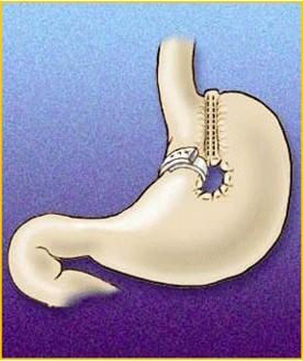 Gastroplastica Verticale: consiste nella creazione di una piccola "tasca" gastrica grande poco più di una siringa (20-30cc) che comunica con il resto dello stomaco tramite uno stretto orifizio