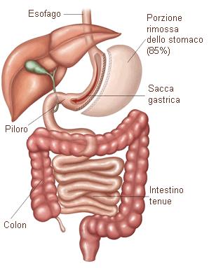 Sleeve gastrectomy (gastrectomia verticale parziale) : consiste nel rimuovere circa l'80% dello stomaco. La rimozione avviene in verticale (gastrectomia verticale parziale).