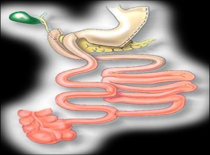 Diversione Bilio-Pancreatica (DBP) variante Duodenal Switch: comprende una resezione gastrica verticale della grande curva gastrica con anastomosi duodeno con intestino tenue ileale.