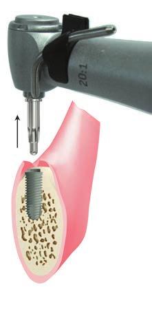 35-40 Ncm 2) Procedura monofasica realizzata con impianti Sommersi e viti di guarigione, con carico dilazionato RPM 15-20 Torque max.