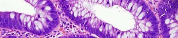 Neoplasia mucosa/displasia nell adenoma