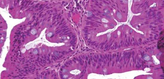 Adenoma serrato tradizionale -raro - lesione polipoide, sessile o peduncolata - presenza di neoplasia mucosa (displasia citolog./ architetturale).