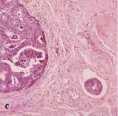 carcinomatose isolate o in piccoli gruppi (meno di 5 cellule) nello stroma sul fronte di avanzamento
