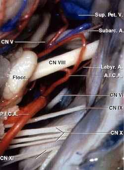 I NEURINOMI DELL'ACUSTICO INTRODUZIONE I neurinomi dell acustico (detti anche swannomi vestibolari) sono lesioni benigne che traggono origine dalle cellule della guaina di Schwann della componente