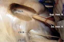 Essi rappresentano le lesioni di maggior riscontro a livello dell angolo pontocerebellare, una regione anatomica della fossa cranica posteriore (Fig.1).