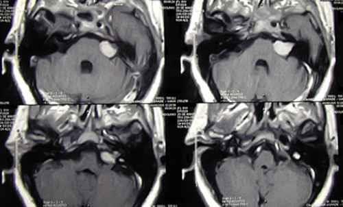 L imaging permette inoltre con un ragionevole margine di certezza di operare diagnosi differenziale con altre lesioni dell angolo pontocerebellare che entrano in diagnosi differenziale con i