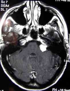 Figura 12 e Figura 13 Controlli Post-operatori Dopo l intervento chirurgico viene eseguita una RMN encefalo con Gadolinio a 3 mesi e poi annuale per circa 5 anni.