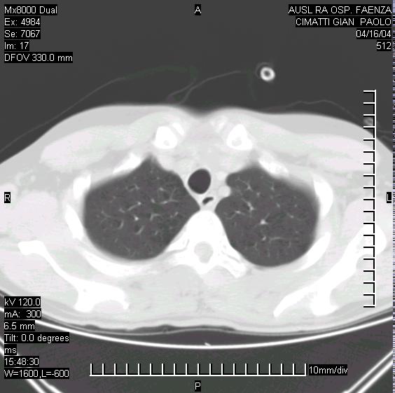 CPAP a 10 cm