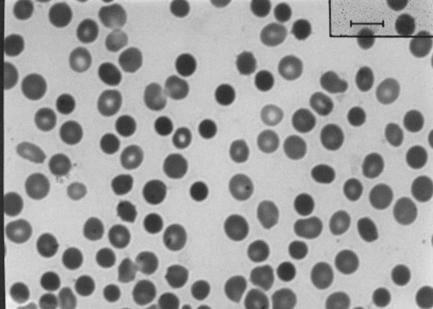 morfologiche dei GR (sferociti, ellissociti,ovalociti, stomatociti, marcata