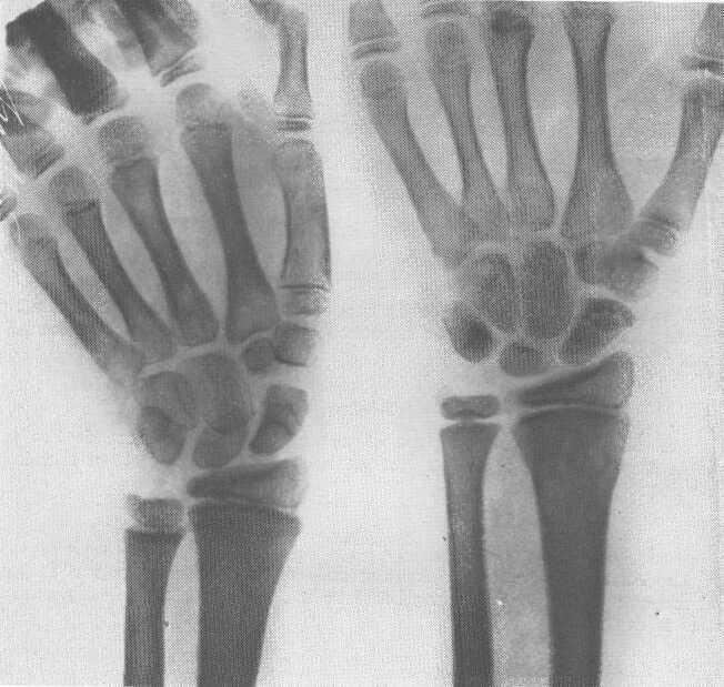 Su due casi di frattura dello scafoide ecc. Fig. 4. Fig. 5. la quale ha fatto sì che ad esser meglio irrorato fosse il frammento prossimale dell'osso.