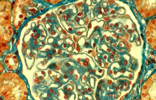 Microscopia Ottica: Ispessimento evidente delle pareti capillari: