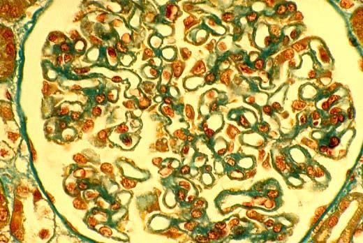 Microscopia Ottica: Pareti capillari ispessite;visibili depositi sul