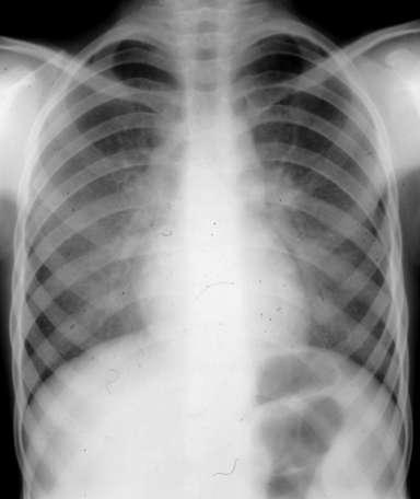 Alterazioni radiografiche Le alterazioni radiografiche più comuni sono rappresentate da infiltrati interstiziali polmonari, quasi sempre bilaterali,